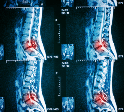 Spinal imaging that is indicating pain and injury in the lumbar spine with a red mark