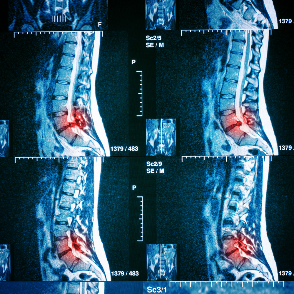 Spinal imaging that is indicating pain and injury in the lumbar spine with a red mark